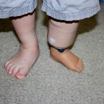 Update on Little Dylan (and his leg amputation)